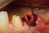 Figure 15  After removal of the defective restoration, it can be seen clinically that the margin of the preparation on the distal of tooth No. 21 was extremely subgingival. The surrounding periodontium was inflamed and hemorrhagic. The laser was used to perform apical repositioning of the bony crest using a closed-flap technique.