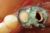 Figure 19  A combination of retraction cord and hemostatic agent (Expasyl, Kerr Corporation) was used to control the periodontal environment for a master impression that would be taken immediately after resective surgery.