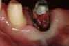 Figure 20  Buccal view of tooth No. 21, 8 weeks after resective surgery and master impression taking. A connective-tissue graft was also placed on the facial aspect to increase the amount of attached tissue. The post and core was cemented to place, but the provisional restoration would remain in place until the graft healed sufficiently, in case the periodontal specialist wanted to add more connective tissue.