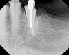 Figure 22  Radiograph taken 8 weeks after closed-flap resective surgery was performed. Note that the bony contour was good, but some minor unevenness was apparent.