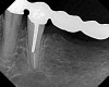 Figure 23  Radiograph taken 6 months after resective surgery and placement of the definitive prosthesis. Note how the bony crest remodeled and was much smoother than seen in the 8-week postoperative radiograph. By making the surgical correction using the closed-flap technique at the time of preparation and impression taking, a significant amount of operative time (> 6 months) was saved and an excellent biologic result was achieved.