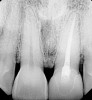 Figure 2  Periapical radiograph of the maxillary left central incisor with vertical root fracture.