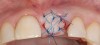 Figure 3  Completed socket graft with free gingival palatal graft.