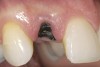 Figure 9  Failing maxillary right lateral incisor with root fracture and subgingival caries.