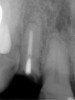 Figure 10  Periapical radiograph of the maxillary right lateral incisor with root fracture.