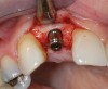 Figure 12  Stage I surgery (implant shown with healing abutment), 4 months after extraction and socket graft.
