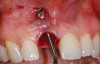 Figure 18  Post-extraction socket defect with loss of labial plate.