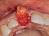 Figure 20  Socket grafted with mineralized irradiated bone allograft.