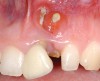 Figure 26  Fractured maxillary left central incisor with fistulous tract.