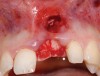 Figure 27  Post-extraction socket defect. Note the extent of soft-tissue dehiscence and complete loss of labial plate.