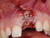 Figure 29  Socket graft completed with mineralized bone allograft, connective tissue graft, and two free gingival tissue grafts.