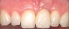 Figure 32  Provisional crown on tooth No. 9, 3 months after the block graft, with tissue grooming completed. Note the central incisor width discrepancy to be corrected with veneer to tooth No. 8.