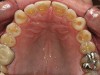 Figure 5  Maxillary occlusal preoperative view.