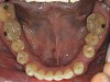 Figure 6  Mandibular occlusal preoperative view.