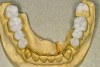 Figure 8  Mandibular wax-up.