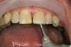 Figure 15  Lingual aspect of teeth sand-blasted with aluminum oxide powder.