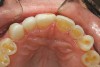 Figure 18  Lingual veneers bonded in place.