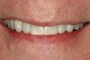 Figure 29  Final postoperative smile.