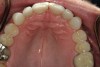 Figure 33  Maxillary occlusal postoperative view.