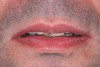 Figure 4  Rest position. Men should show an average of 1.91 mm and women 3.4 mm of central incisor at rest. Tooth No. 9 would be a good reference length for the patient in this photograph.