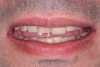 Figure 6  The ‚ÄúE‚Äù position. In this position, a central incisor should ideally fall approximately 50% to 60% of the distance between the upper and lower lip.
