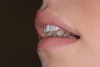 Figure 7  Natural flaccid lip. This author feels it is beneficial to have reference of the flaccid interaction of the lip against the teeth.