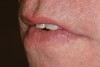 Figure 8  This photograph shows the phonetic interaction of the incisal edges and the lower lip. Contact should be in the wet vermilion region of the lip and not on the cutaneous portion.