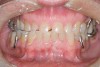 Figure 9  This patient has undergone severe occlusal wear and breakdown. Simply adding incisal length to improve the esthetics may not be the best course of action.