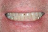 Figure 10  This is the ‚ÄúE‚Äù position of the patient in Figure 9. Notice that the incisal edges are close to the correct position despite the excessive loss of tooth length due to wear.