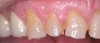 Figure 11  Crown lengthening was necessary to esthetically and functionally restore the patient in Figure 9 and 10. The incisal edge position was maintained and the teeth were restored to ideal length.