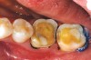 Figure 1b  The teeth were prepared for adhesively retained restorations. Note the significant ring of remaining enamel.