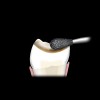 Figure 2  The occlusal surface of the tooth is reduced to provide 2 mm of porcelain thickness in the definitive restoration.