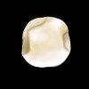 Figure 4  A smooth shoulder, 1 mm in depth and 90¬∞ to the cavosurface, is carried to the lingual aspect of the tooth, to restore a fractured cusp or replace an existing restoration.