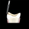 Figure 5  A chamfer is established on the facial aspect of the preparation to create an esthetic transition at the tooth/ceramic interface.