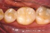 Figure 6c  The final restoration addresses the occlusal, proximal, and lingual compromises of the tooth yet preserves facial tooth structure.
