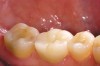 Figure 6d  The butt margin on the lingual aspect of the tooth provides an anatomical guide for the ceramist and facilitates restoration of original tooth contours.