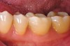 Figure 6e  A 2 mm facial chamfer provides an acceptable framework in which to optically blend the tooth/ceramic interface.