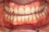 Figure 7c  Harmonious blending of indirect restorations and natural tooth structure provides improved esthetics and conservation of tooth structure.