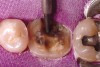 Figure 9b  At the time of delivery of the definitive restoration, the provisional restoration is removed and the preparation is cleaned using low-pressure particle abrasion.