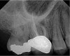 Figure 1  Preoperative view of tooth No. 3.