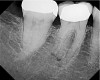 Figure 2  Preoperative view of tooth No. 30.