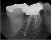 Figure 3  Postoperative view of tooth No. 30.