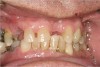 Figure 10b  Supra-eruption of the opposing arch, thus diminishing crown height space.