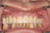 Figure 10c  Traditional fixed prosthodontics performed to level the opposing arch and regain sufficient crown height space.