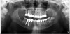 Figure 10d  Traditional fixed prosthodontics performed to level the opposing arch and regain sufficient crown height space.