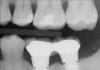 Figure 13  Radiograph depicting the necessity of horizontal placement parameters to prevent vertical defects from becoming horizontal defects.