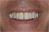 Figure 5  Compare and Contrast, Pre-extraction dentate state.