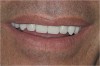 Figure 6  Compare and Contrast, Completed maxillary implant bar-overdenture.