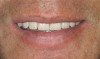 Figure 10  Square Form , Complete maxillary and mandibular dentures. .