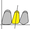 Figure 20  The maxillary lateral incisor has slightly more distal inclination than the central incisor.